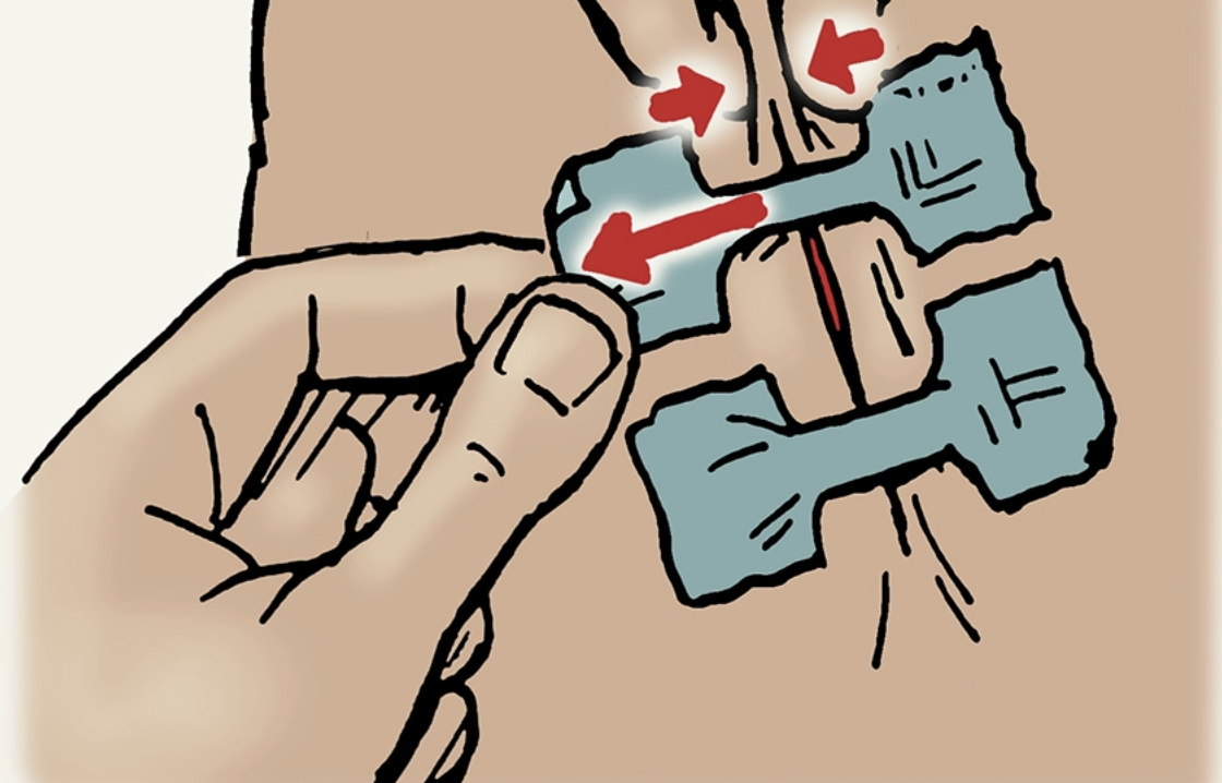 A person is using an improvised method to close a wound on another person's stomach.